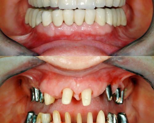 Full Mouth Rehabilitation